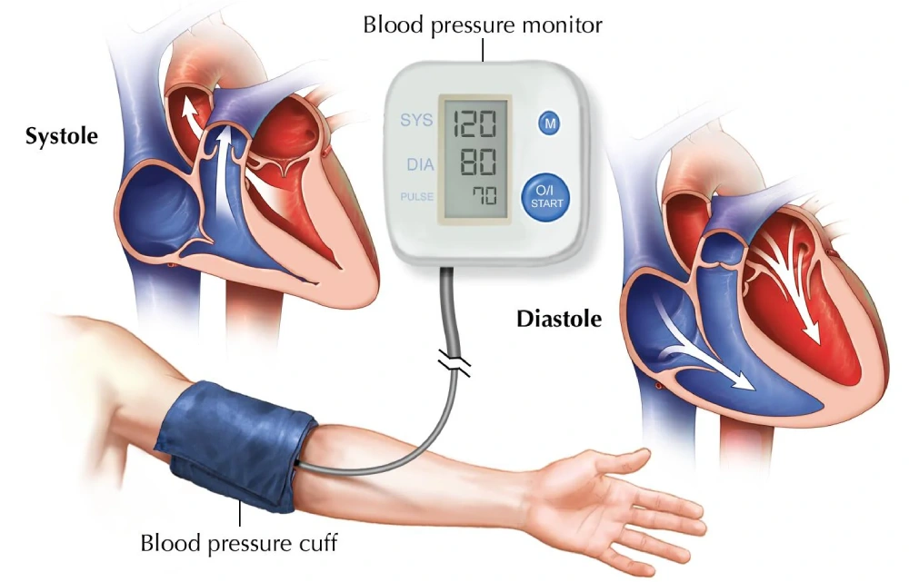 کنترل فشار خون بالا در بیماران قلبی