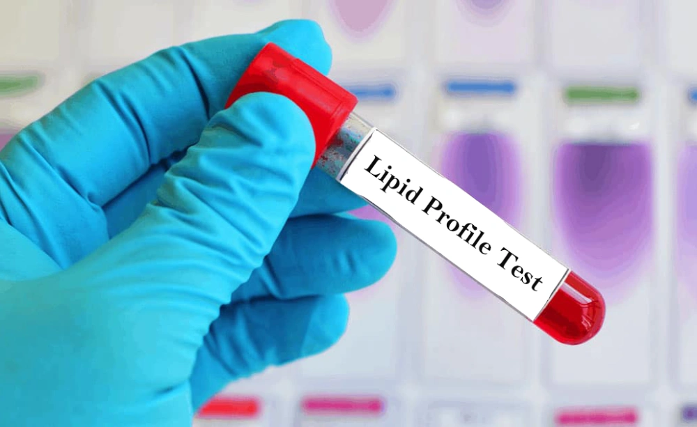 آزمایش لیپید پروفایل برای پیشگیری از بیماری قلبی در بزرگسالان
